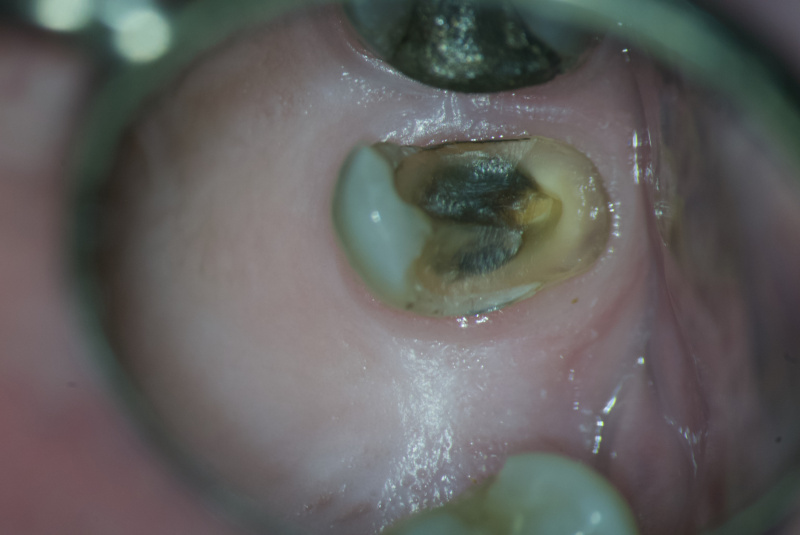 Remodelácia zlomeného zuba na počkanie