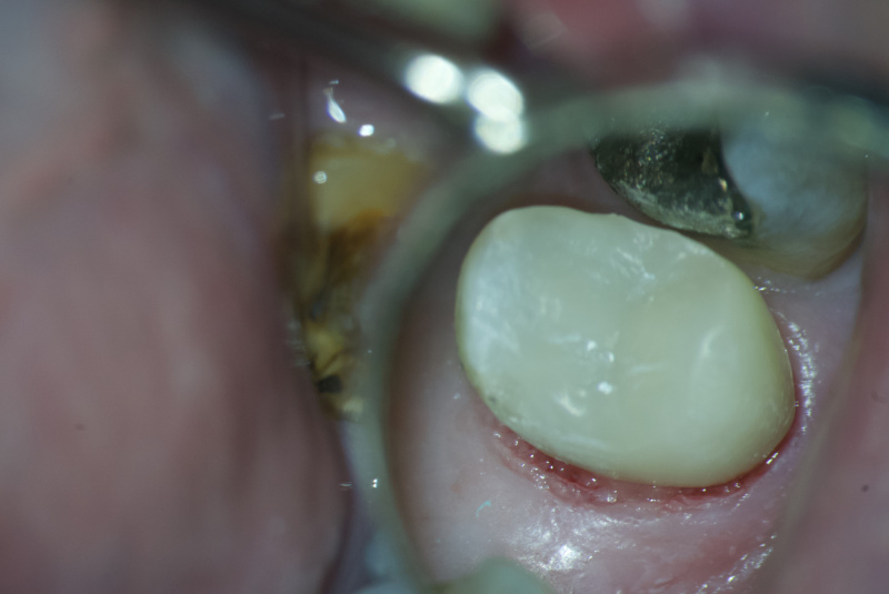 Remodelácia zlomeného zuba na počkanie